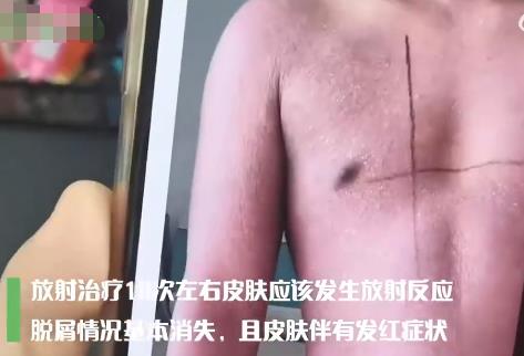 23歲小伙起紅疹被誤診6年查出癌癥 原因揭秘簡(jiǎn)直讓人驚呆了