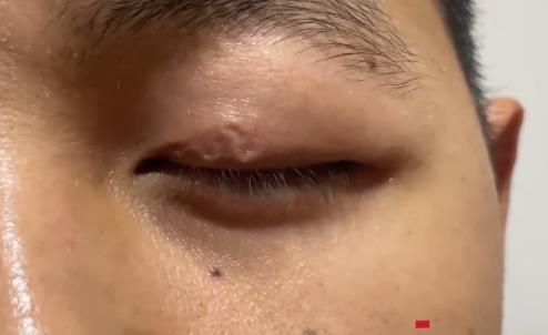 男子左眼皮異常抖動(dòng)有蟲游走 到底是什么情況?