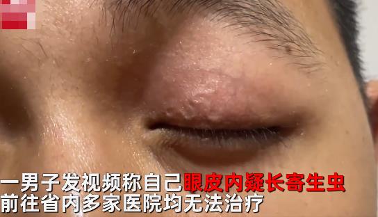 男子左眼皮異常抖動(dòng)有蟲游走 背后真相曝光太驚悚了