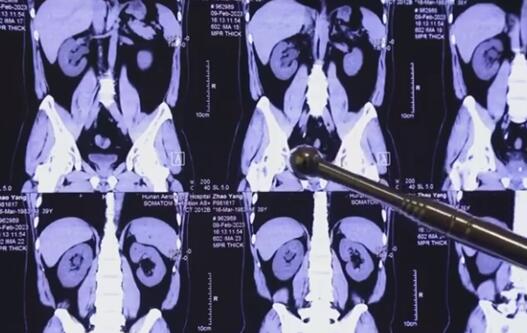 程序員20年喝近2噸可樂屢患結(jié)石 原因竟是這樣實(shí)在是太意外了
