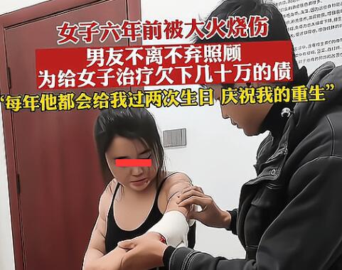 男子照顧大面積燒傷女友6年 照片曝光直接讓人大呼意外