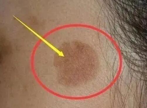 25歲女生長期熬夜長出老年斑 真相曝光簡直太驚人了