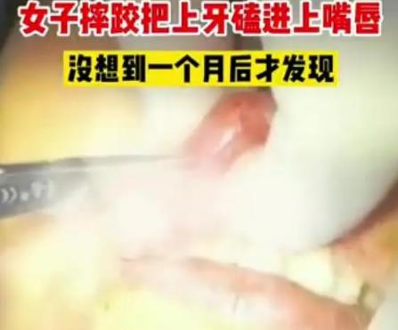 女子摔跤上牙磕進(jìn)嘴唇1月后才發(fā)現(xiàn) 照片曝光實(shí)在是太嚇人了