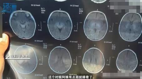 月嫂拍嗝時打盹致嬰兒頭頂骨骨折 事件始末是什么? 