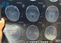 月嫂拍嗝時(shí)打盹致嬰兒頭頂骨骨折 背后原因簡直驚呆了眾人