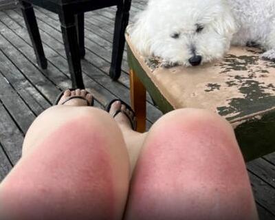 女子云南穿破洞褲7小時腿被曬傷 照片揭秘簡直太意外了