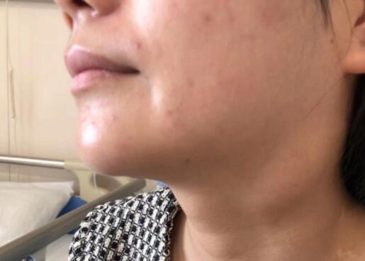 少女連續(xù)數(shù)日高燒不退確診接吻病 到底是什么情況?