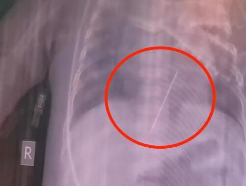 女嬰心臟扎進(jìn)一根4厘米繡花針 結(jié)果真的令人大吃一驚