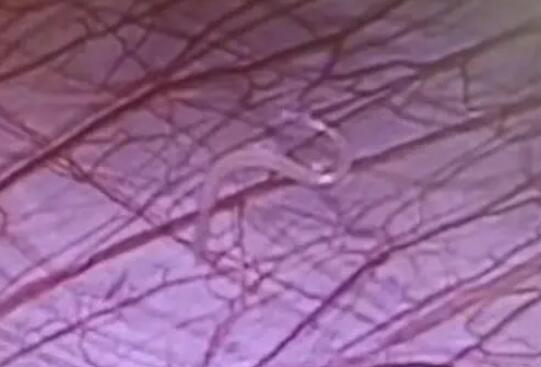 女孩外地求醫(yī) 切開闌尾有蟲子游出 長約1cm太嚇人了