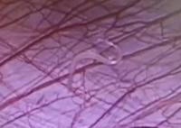 女孩外地求醫(yī) 切開闌尾有蟲子游出 這條游動“小蟲”到底是什么呢?