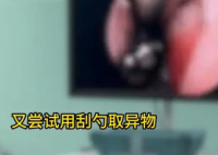 男孩鼻子惡臭兩年 取出顆生銹螺絲 究竟是怎么回事？