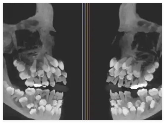 巴西11歲女孩拔牙時(shí)發(fā)現(xiàn)81顆牙齒 始料未及真相簡(jiǎn)直太意外了
