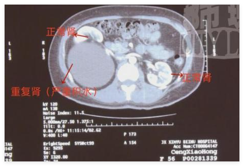 江西新余女子意外發(fā)現(xiàn)三個(gè)腎 簡直太意外了