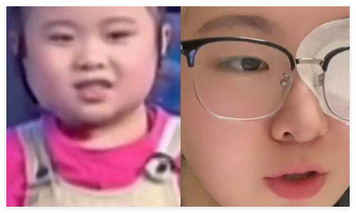知名童星“秦虹一枝花”右眼失明 原因竟是這樣太無奈了